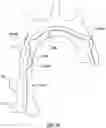 Fig. 16 - Delivery system having an integral centering mechanism for positioning a valve prosthesis in situ