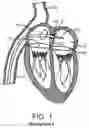 Fig. 02 - Delivery systems with tethers for prosthetic heart valve devices and associated methods