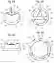 Fig. 03 - Method for converting an annuloplasty ring in vivo