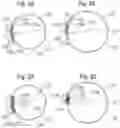 Fig. 05 - Method for converting an annuloplasty ring in vivo