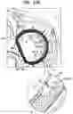 Fig. 42 - Annuloplasty implants