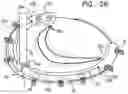 Fig. 45 - Annuloplasty implants
