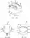 Fig. 17 - Total joint replacement infection control devices and methods