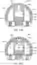 Fig. 25 - Total joint replacement infection control devices and methods