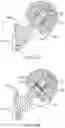 Fig. 27 - Total joint replacement infection control devices and methods