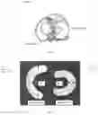 Fig. 02 - COLLAGEN-BASED MENISCUS IMPLANTS