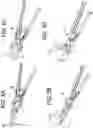 Fig. 05 - Lateral spondylolisthesis reduction cage