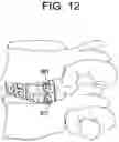 Fig. 12 - Lateral spondylolisthesis reduction cage