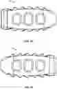 Fig. 18 - Spinal surgery systems and methods