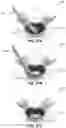 Fig. 80 - Spinal surgery systems and methods