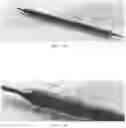 Fig. 05 - Radially rigid and longitudinally flexible multi-element intravascular stent