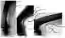 Fig. 07 - Radially rigid and longitudinally flexible multi-element intravascular stent