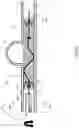Fig. 10 - Stent delivery with expansion assisting delivery wire
