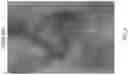Fig. 12 - Stent delivery with expansion assisting delivery wire