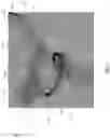 Fig. 13 - Stent delivery with expansion assisting delivery wire
