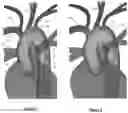 Fig. 03 - Apparatus and method for improved access of procedural catheter in tortuous vessels