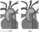 Fig. 04 - Apparatus and method for improved access of procedural catheter in tortuous vessels