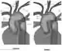 Fig. 05 - Apparatus and method for improved access of procedural catheter in tortuous vessels