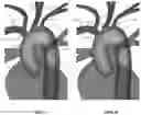 Fig. 09 - Apparatus and method for improved access of procedural catheter in tortuous vessels
