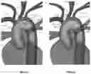 Fig. 10 - Apparatus and method for improved access of procedural catheter in tortuous vessels