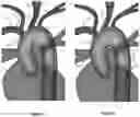 Fig. 11 - Apparatus and method for improved access of procedural catheter in tortuous vessels