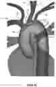 Fig. 12 - Apparatus and method for improved access of procedural catheter in tortuous vessels