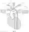 Fig. 15 - Apparatus and method for improved access of procedural catheter in tortuous vessels