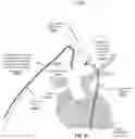 Fig. 28 - Apparatus and method for improved access of procedural catheter in tortuous vessels