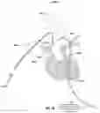 Fig. 33 - Apparatus and method for improved access of procedural catheter in tortuous vessels
