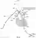 Fig. 34 - Apparatus and method for improved access of procedural catheter in tortuous vessels