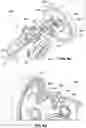 Fig. 21 - Systems, devices, and methods for the accurate deployment and imaging of an implant in the prostatic urethra