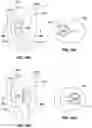 Fig. 37 - Systems, devices, and methods for the accurate deployment and imaging of an implant in the prostatic urethra