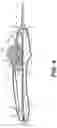 Fig. 05 - Rotary handle stent delivery system and method