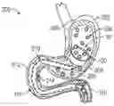 Fig. 01 - TRANSIENT IMPLANTABLE DEVICE TO CONTROL ABSORPTION OF NUTRIENTS