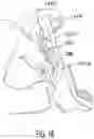 Fig. 16 - Forward head posture correction collar assembly