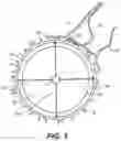 Fig. 04 - Intraocular implants and methods and kits therefor