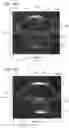 Fig. 26 - Optical surface identification for laser eye surgery