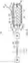 Fig. 14 - Soft-tissue treatment with negative pressure
