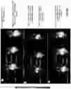 Fig. 09 - Tumor treatment methods using cells that localize to the tumor