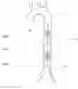 Fig. 01 - Endovascular perfusion augmentation for critical care