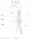 Fig. 09 - Endovascular perfusion augmentation for critical care