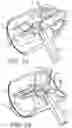 Fig. 07 - Breathing Assistance Device with Nebulizer