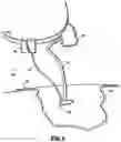 Fig. 05 - SELF CONTAINED WOUND DRESSING APPARATUS