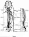 Fig. 03 - Implantable lead affixation structure for nerve stimulation to alleviate bladder dysfunction and other indication