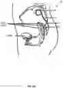 Fig. 06 - Implantable lead affixation structure for nerve stimulation to alleviate bladder dysfunction and other indication