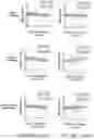 Fig. 35 - Method of neural intervention for the treatment of affective neuropsychiatric disorders
