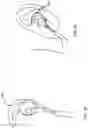 Fig. 15 - Methods and apparatuses for transdermal stimulation of the outer ear
