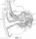 Fig. 02 - Bilateral synchronized channel selection for cochlear implants