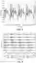 Fig. 04 - Bilateral synchronized channel selection for cochlear implants