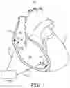 Fig. 02 - Multi-chamber intracardiac pacing system